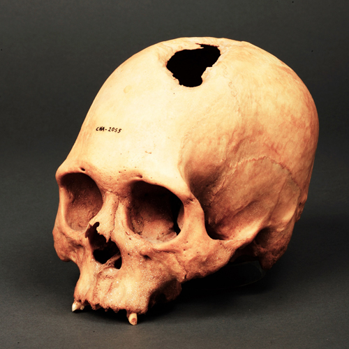 《頭蓋穿孔された頭》 チリバヤ文化(紀元900年頃から1440年頃) ペルー文化省・ミイラ研究所・チリバヤ博物館所蔵 撮影 義井豊